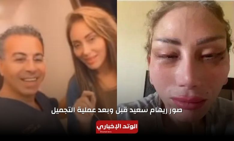 صور ريهام سعيد قبل وبعد عملية التجميل التي تسببت في تشويه وجهها