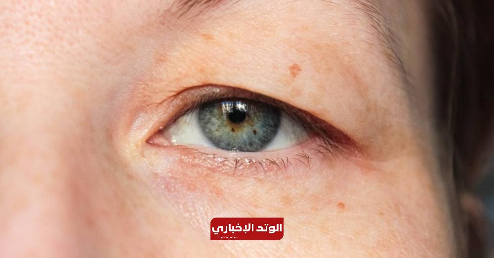 5 أسباب لارتخاء جلد الجفن العلوي