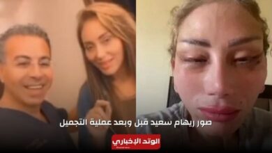صور ريهام سعيد قبل وبعد عملية التجميل التي تسببت في تشويه وجهها